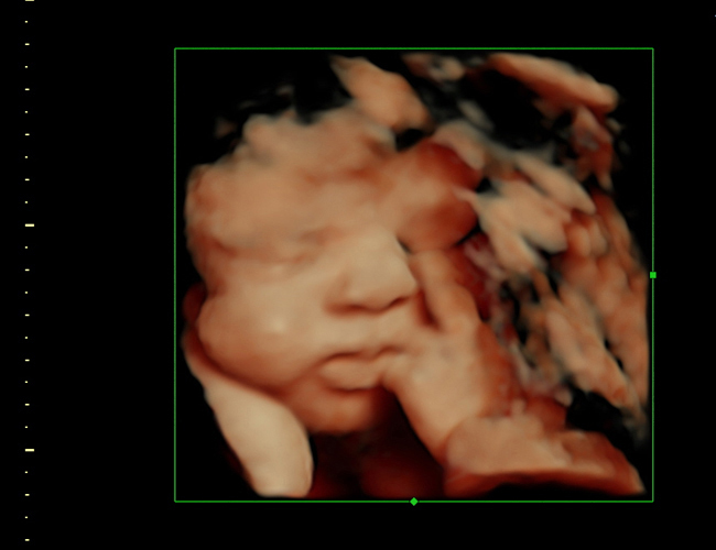 3D ultrasound image at 33 weeks